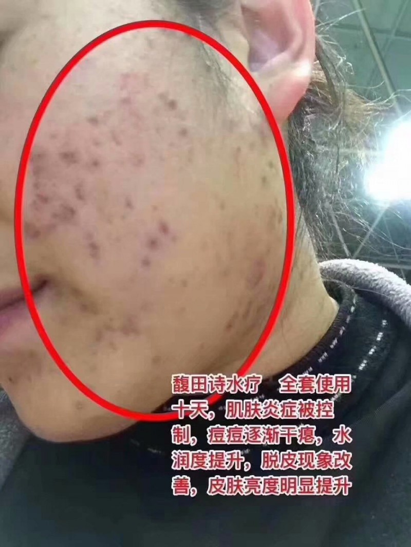 馥田詩水療，全套使用十天，肌膚炎癥被控制，痘痘逐漸干癟，水潤度提升，脫皮現(xiàn)象改善，皮膚亮度明顯提升。